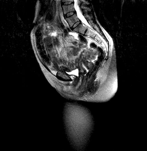 Pelvic Floor MRI scan 2